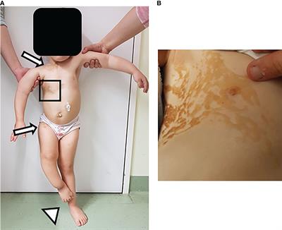 A Case Report: First Long-Term Treatment With Burosumab in a Patient With Cutaneous-Skeletal Hypophosphatemia Syndrome